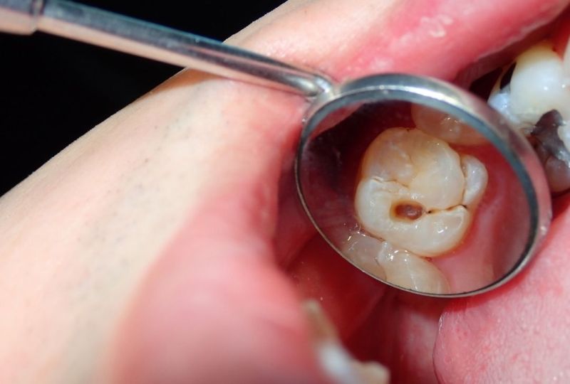 Gangrena dentara
